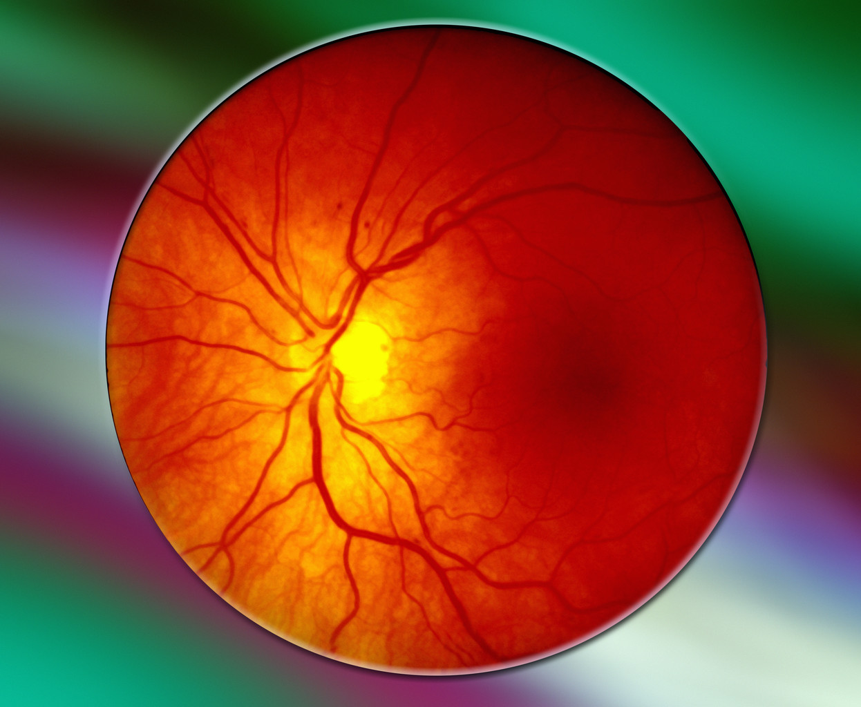 Сужение сосудов глаз. Гипертоническая ангиопатия и ретинопатия. Пролиферативная диабетическая ретинопатия. Гипертоническая ангиопатия сетчатки. Ангиопатия сетчатки глаза ou.